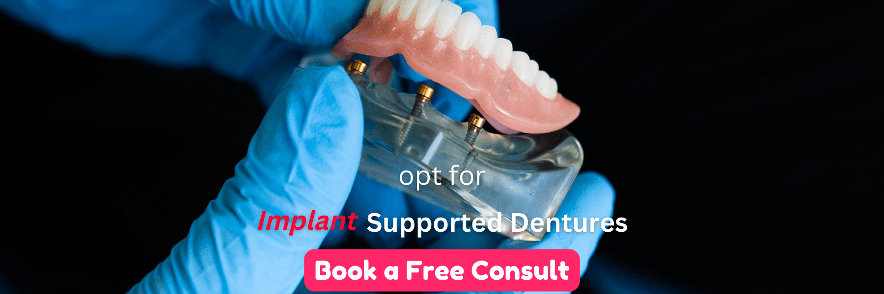 Implant supported dentures